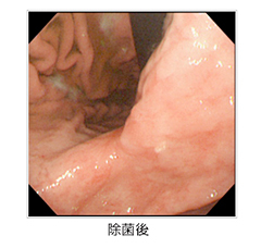 胃潰瘍の内視鏡写真