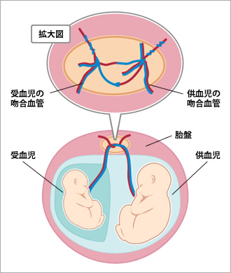 双胎間輸血症候群(TTTS)