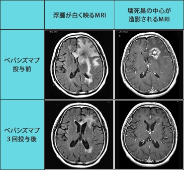 脳のMRI写真