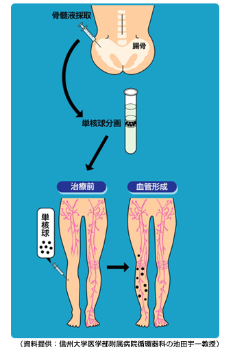 図1．骨髄液の採取・移植の流れ