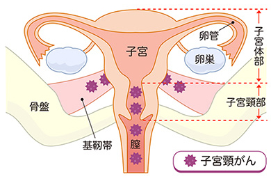 図1　子宮頸がんの特徴