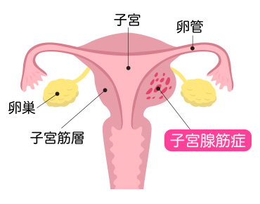 子宮腺筋症